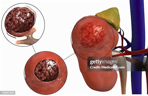 Adrenal Gland Tumor Photos And Premium High Res Pictures Getty Images