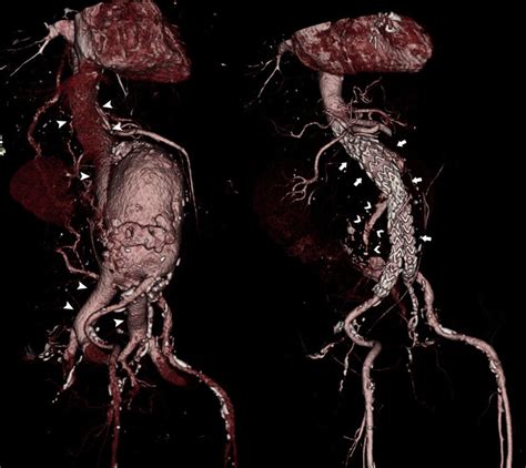 Three Dimensional Ct Angiography Reconstruction Images The Left Image Download Scientific