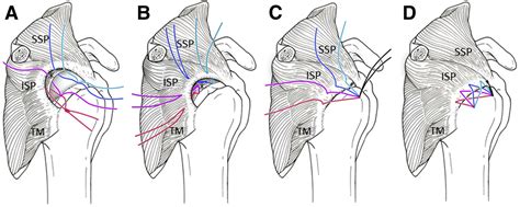 Repair Of Rotator Cuff Tear With Delamination Independent Repairs Of