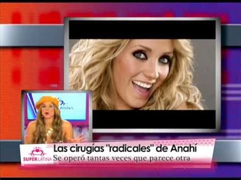 Anahi Antes Y Despues Dela Cirugia