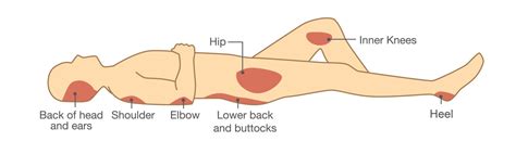 Airisana Guide To Pressure Injury Prevention