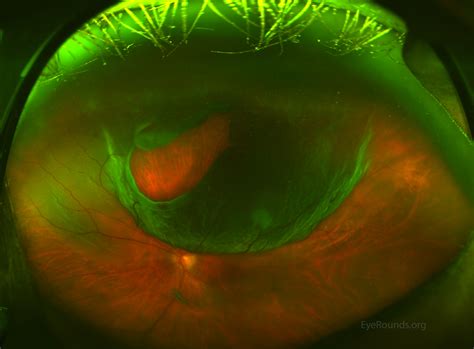 Atlas Entry Rhegmatogenous Retinal Detachment