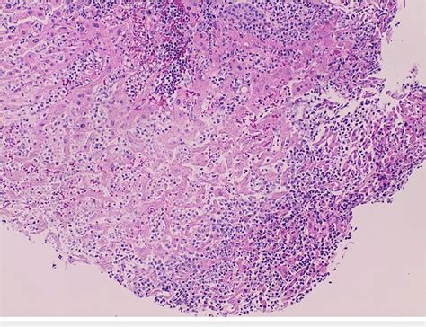 Liver Abscess Aspiration Histology H E X Demonstrates Liver Tissue