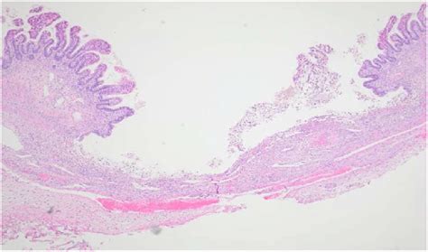 Early Ischemic Necrosis Of Small Bowel Wall With Loss Of Surface Mucosa