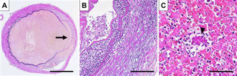 Histopathological Findings Of The Left Middle Cerebral Artery A