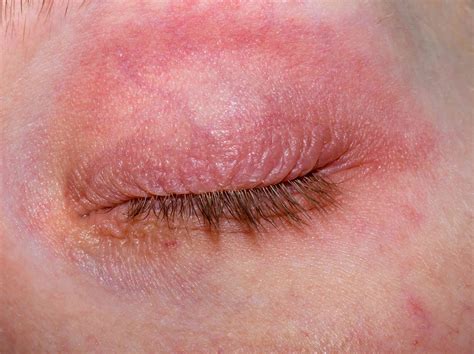 What Can Cause A Rash Around The Eyes