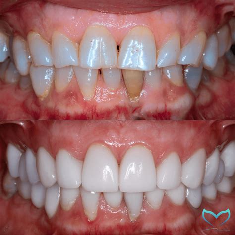 Composite VS Porcelain Veneers – You Need Everything