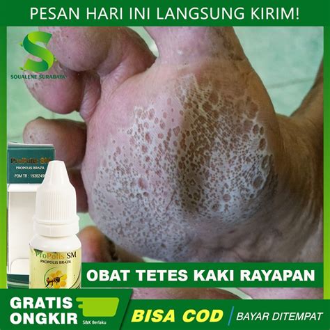 Jual Obat Tetes Kaki Rayapan Obat Telapak Kaki Bolong Bolong Kaki