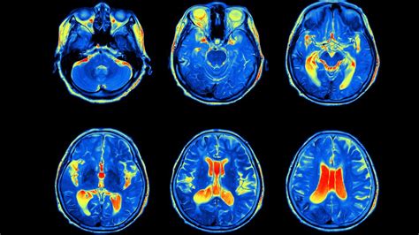 Brain Scans Could Help People With Bipolar Disorder Get The Treatment