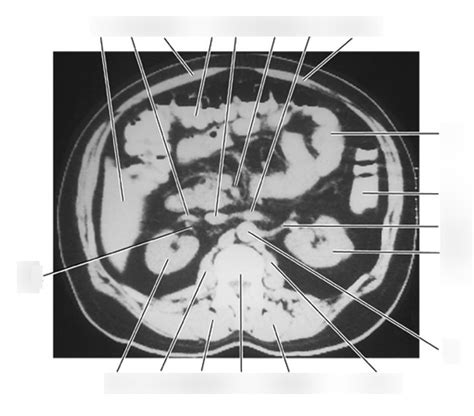 TRANSVERSE CT OF ABDOMEN 4 Diagram Quizlet