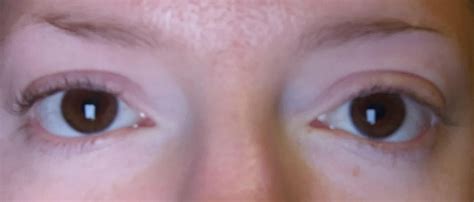 Uneven eyelid fixes? : r/PlasticSurgery