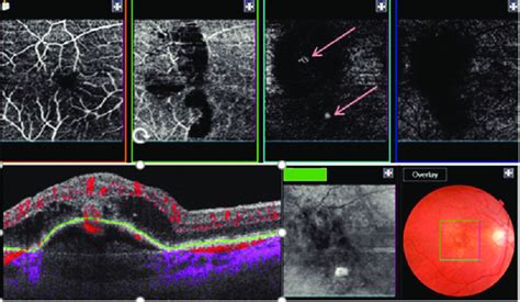 Right Eye Type 3 Choroidal Neovascularisation Retinal Angiomatous