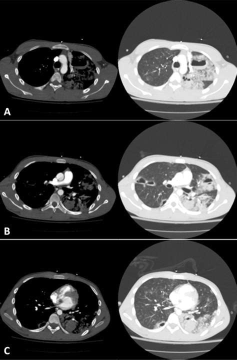 Southwest Journal Of Pulmonary Critical Care And Sleep Imaging Medical Image Of The Week