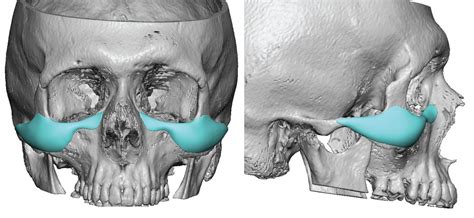 The Anatomic Basis for Custom Infraorbital-Malar Implants - Explore Plastic Surgery