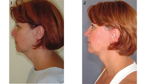 Continued A C E G I This 42 Year Old Woman Presented For Facial