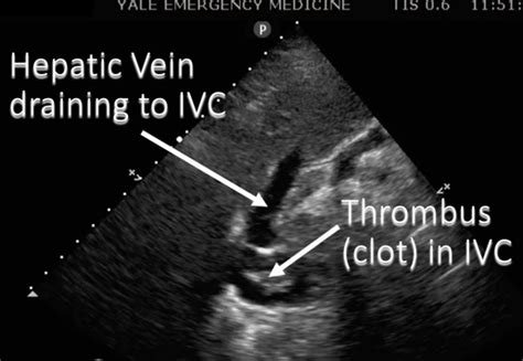 Aorta and IVC Ultrasound: IVC Abnormalities