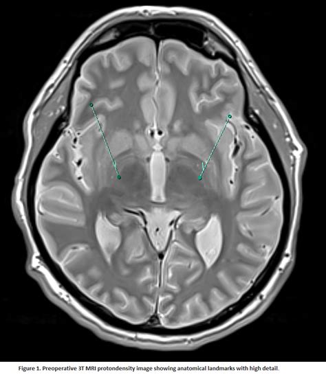 Successful Treatment Of Secondary Dystonia With Deep Brain Stimulation