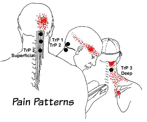 Tension Headache Relief, Headache Causes, Headache Treatment, Migraine ...