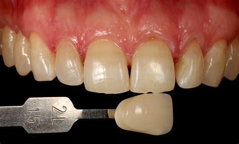 Overcoming challenges in teeth whitening: tetracycline staining. - FGM ...