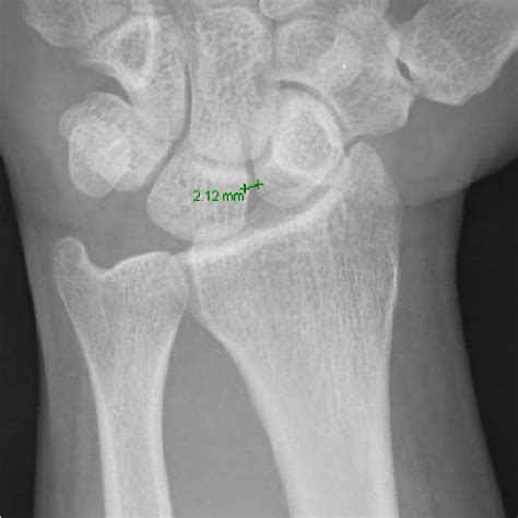 Measurement Of Scapholunate Angle 3 Ulnar Variance Figure 3 A Line