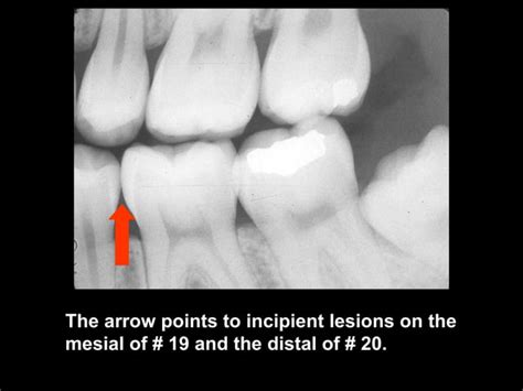 Radiographic Caries Diagnosis Ppt