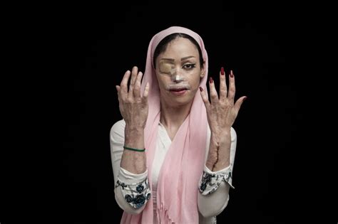 Powerful Images Of Acid Attack Survivors Reveal The True Face Of