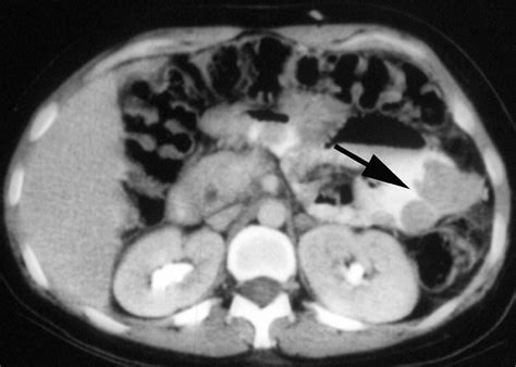 Gastrointestinal Stromal Tumors In Patients With Neurofibromatosis