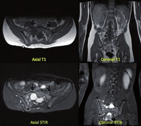 These Mri Scans Show A Year Old Female With Right Sacroiliac Joint