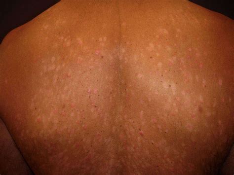 Pityriasis Rosea On Black Skin Hot Sex Picture