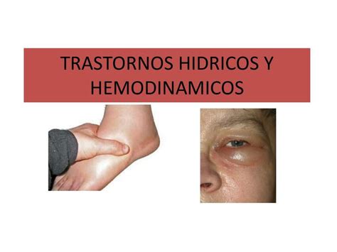 Trastornos Hidricos Jennifer Udocz