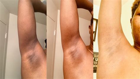 How To Get Rid Of Dark Armpits Instantly Permanent Works