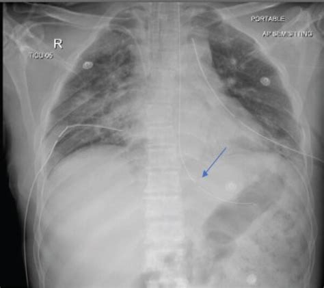 Chest X Ray A B Shows Endotracheal Tube Orogastric Tube And Left