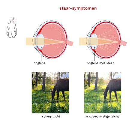 Wat Is Staar Cataract Oorzaken Symptomen Bergman Clinics