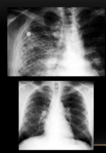 Interstitial Lung Disease Idiopathic Pulmonary Fibrosis Flashcards