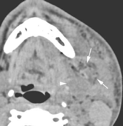 Parotid Infections | Radiology Key