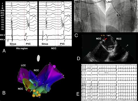 How To Map And Ablate Parahisian Ventricular Arrhythmias Heart Rhythm