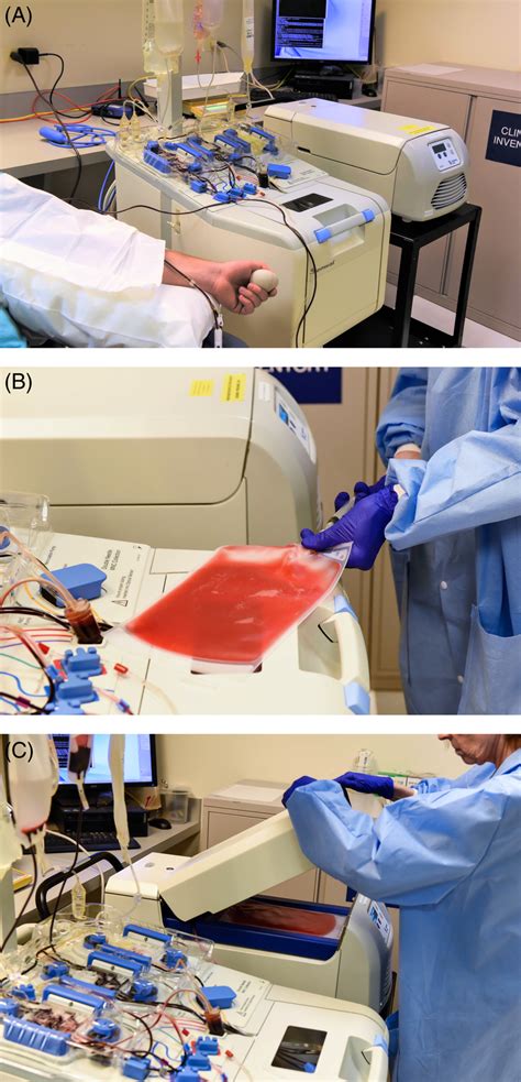 pilot study     extracorporeal photopheresis system