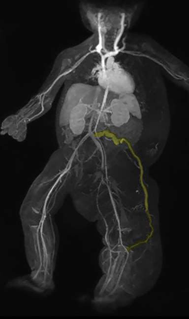 Klippel-Trenaunay Syndrome | Applied Radiology