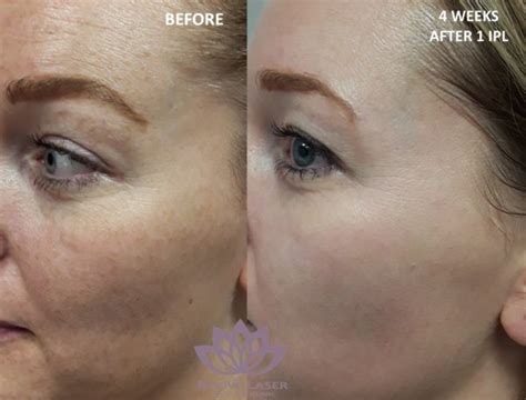 IPL before and after NEW - Revive Laser and Skin Clinic