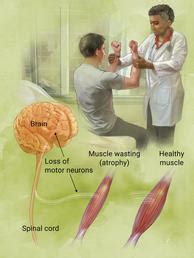 Understanding Lou Gehrigs Disease - Lou Gehrig's Disease