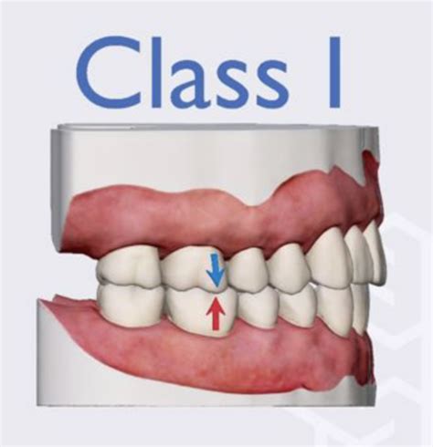 Orofacial Midterm Angle S Class Occlusion Flashcards Quizlet