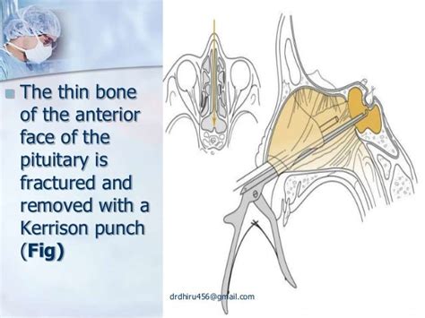 Transsphenoidal hypophysectomy (by drdhiru456)