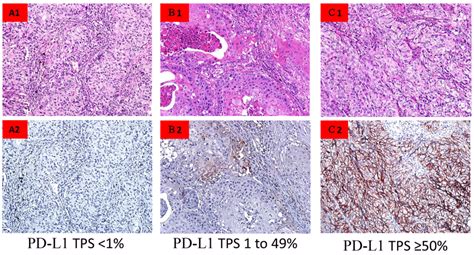 Pd L1 Immunohistocehmistry Labeling In Nsclc Tumor Specimens A Pd L1