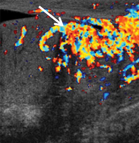 Testicular Tumors What Radiologists Need To Know—differential