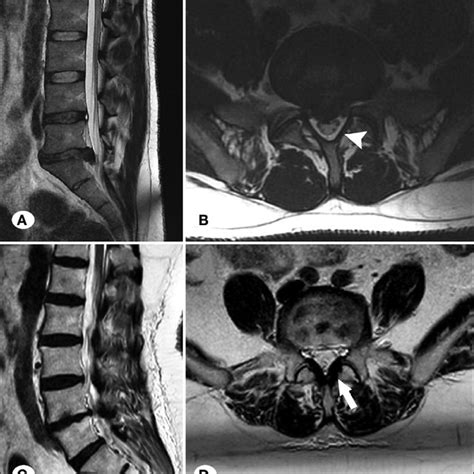 A B Microscopic View Of Ligamentum Flavum In Lumbar Spinal Stenosis Download Scientific