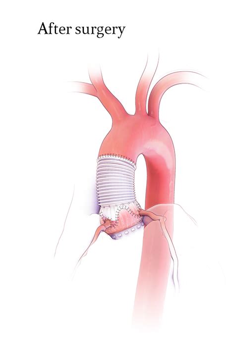 Emory Aortic Center Patient Education