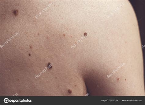 Nevus melanocítico algunos de ellos displásicos o atípicos en un