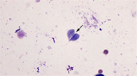 Giardia Lamblia In Urine