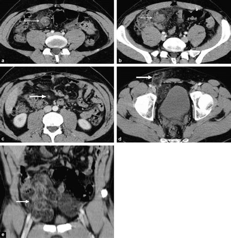 Tdm Abdominale Apr S Injection De Produit De Contraste En Coupes