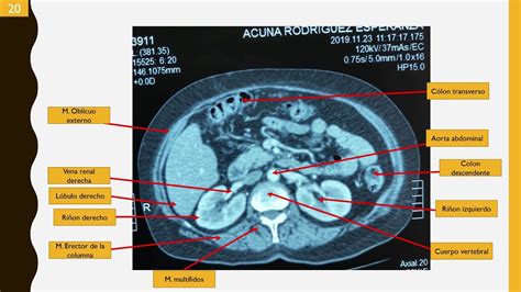 anatomía XXXI TOMOGRAFÍA COMPUTARIZADA EN CORTE AXIAL DE ABDOMEN Y